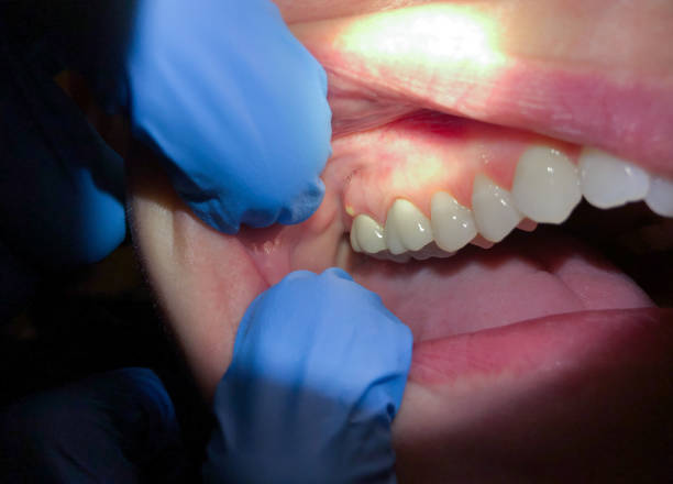 Best Emergency Denture Repair in Nags Head, NC